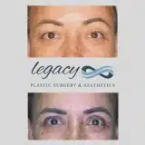 Brachioplasty_40