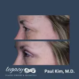 Brachioplasty_42