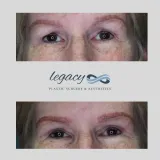 Brachioplasty_45