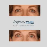 Brachioplasty_46