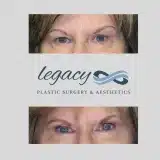 Brachioplasty_48