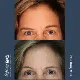 Brachioplasty_50