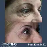 Brachioplasty_51