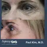 Brachioplasty_52