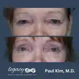 Brachioplasty_53