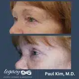 Brachioplasty_54