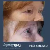 Brachioplasty_55