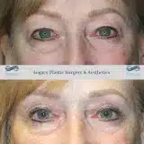 Brachioplasty_57