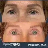 Brachioplasty_60