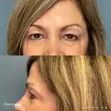 Brachioplasty_61