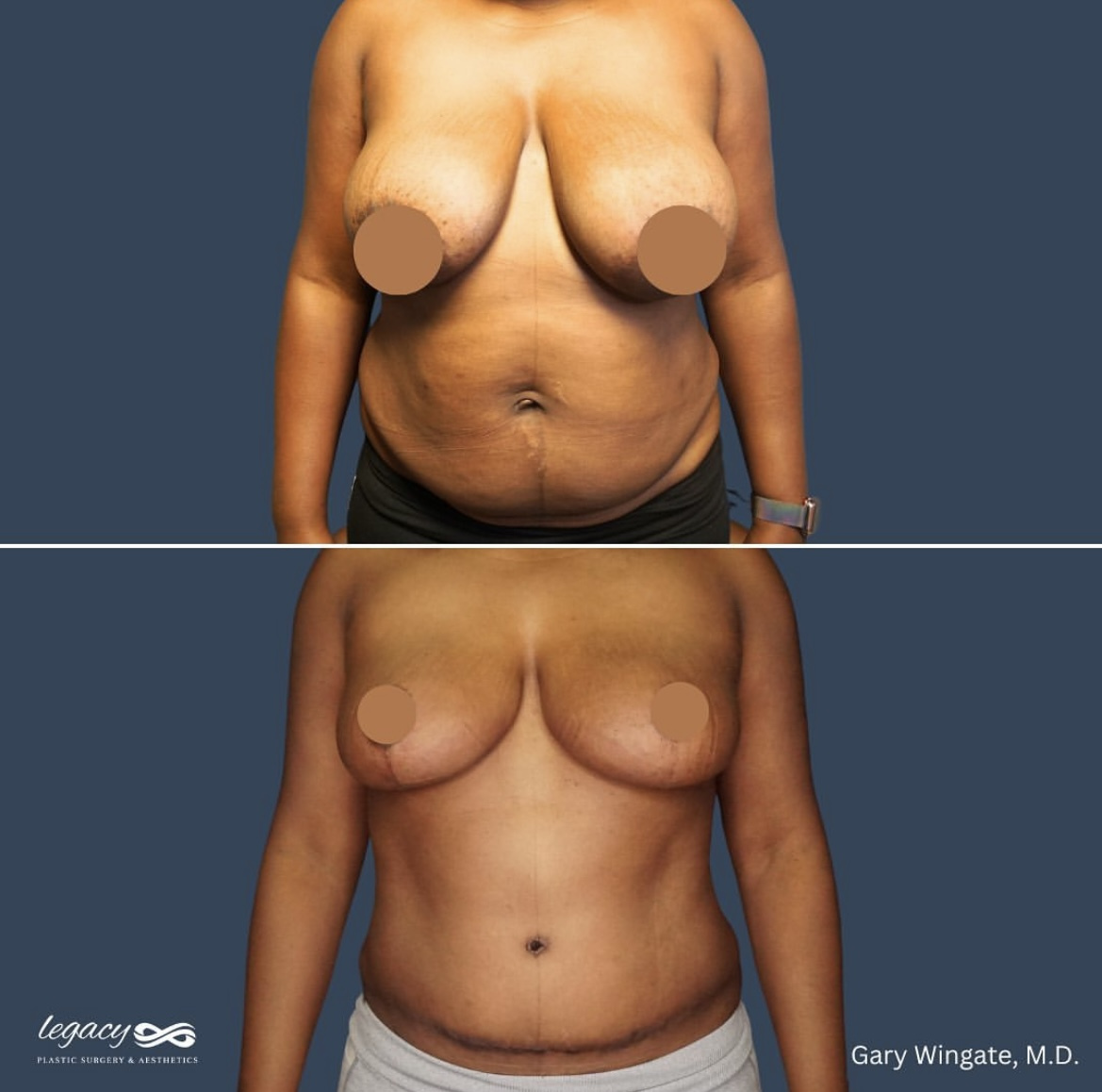 Breast-Reduction-_-Abdominoplasty