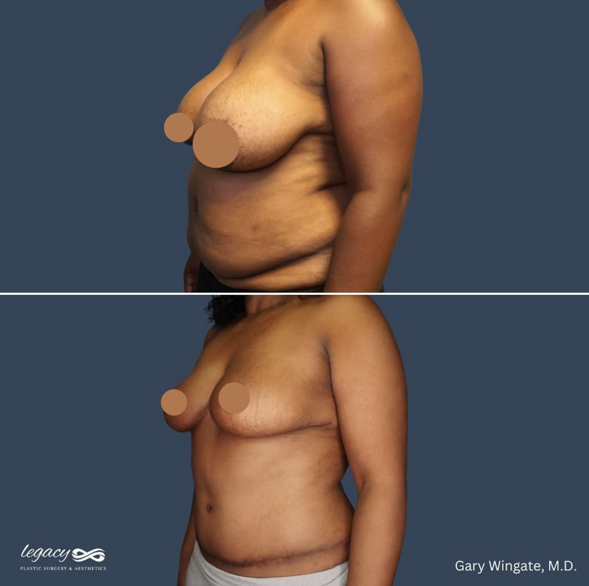 Breast-Reduction-_-Abdominoplasty1