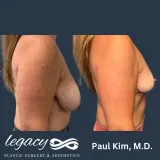 Breast-Reduction-03