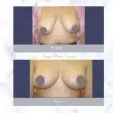 Breast-Reduction-05