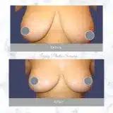 Breast-Reduction-11
