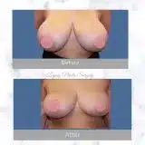Breast-Reduction-12