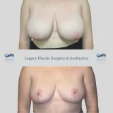 Breast-Reduction-13