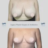 Breast-Reduction-14