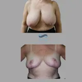 Breast-Reduction-21