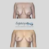 Breast-Reduction-26