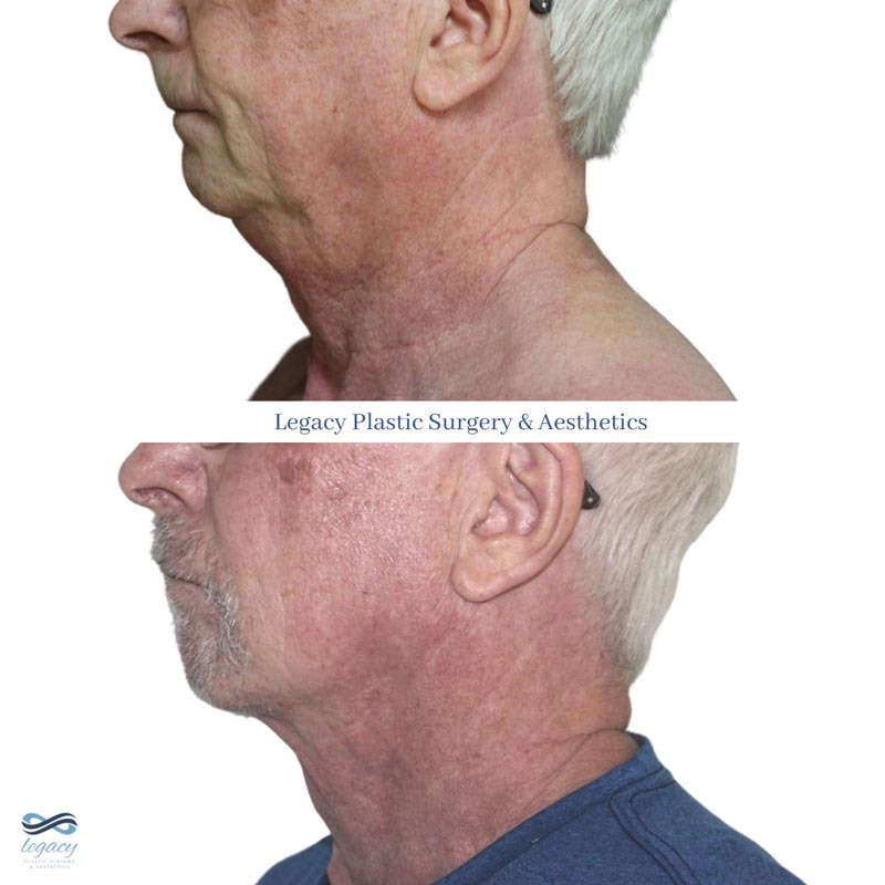 BodyTite and FaceTite Legacy Plastic Surgery
