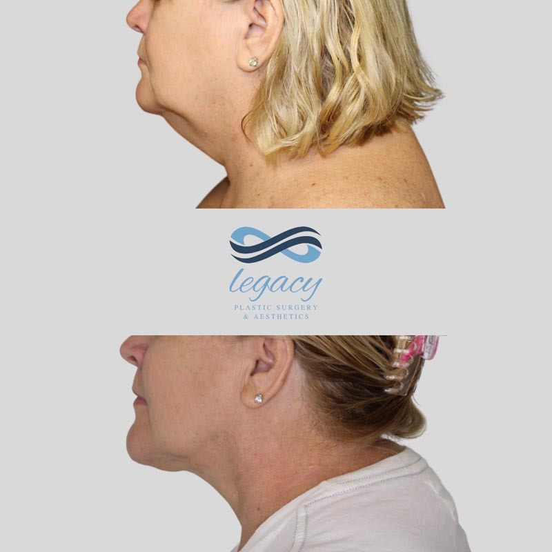 BodyTite and FaceTite Legacy Plastic Surgery
