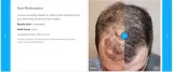 Hair-transplant-Neograft-10
