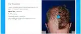 Hair-transplant-Neograft-11