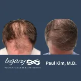 Hair-transplant-Neograft-12
