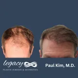 Hair-transplant-Neograft-13