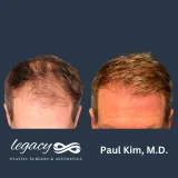 Hair-transplant-Neograft-14