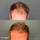 Hair-transplant-Neograft-15