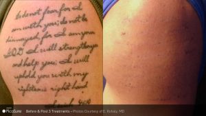 , Effective Tattoo Removal In Paoli, Pa