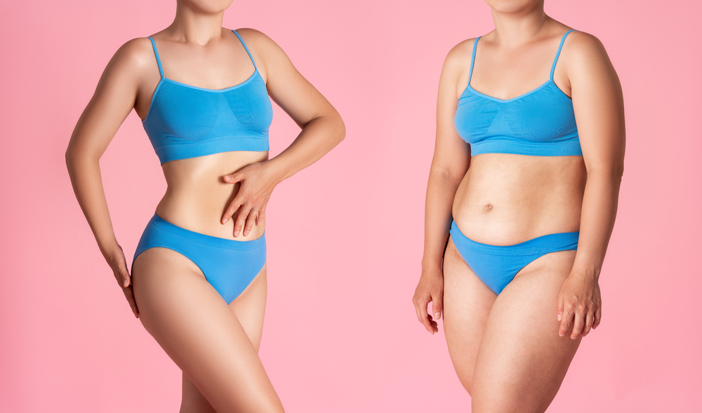 The Difference Between Liposuction and a Tummy Tuck | Legacy Plastic Surgery & Aesthetics