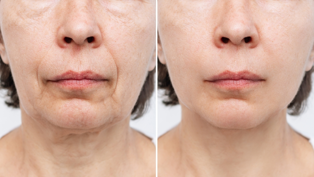 Diving Into How a Facelift Is Performed | Legacy Plastic Surgery & Aesthetics