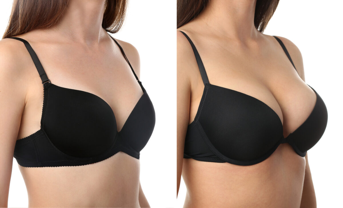 The Pros and Cons of Autologous Breast Augmentation