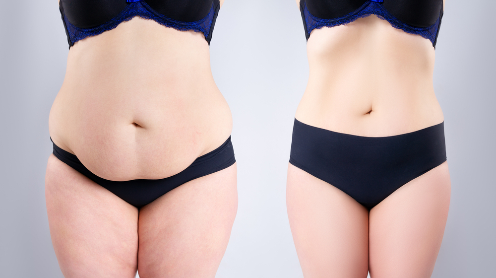 From Start to Finish: How Long Does a Tummy Tuck Take? | Legacy Plastic Surgery & Aesthetics